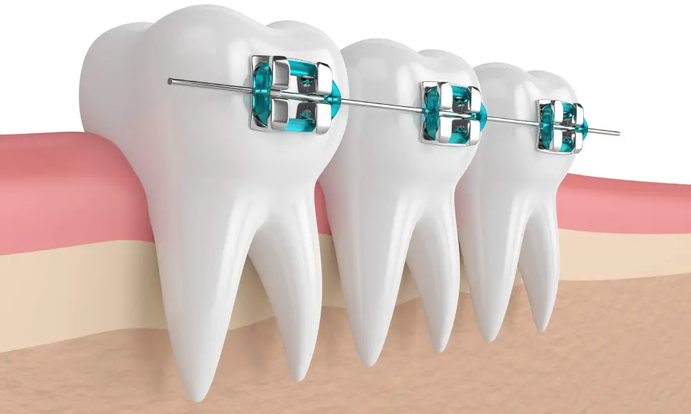 Braces Treatment in Egmore