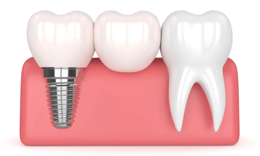 Dental Implants in Egmore