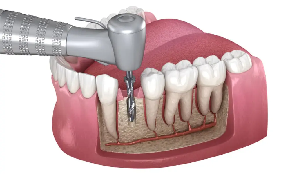 Root Canal Treatment in Egmore