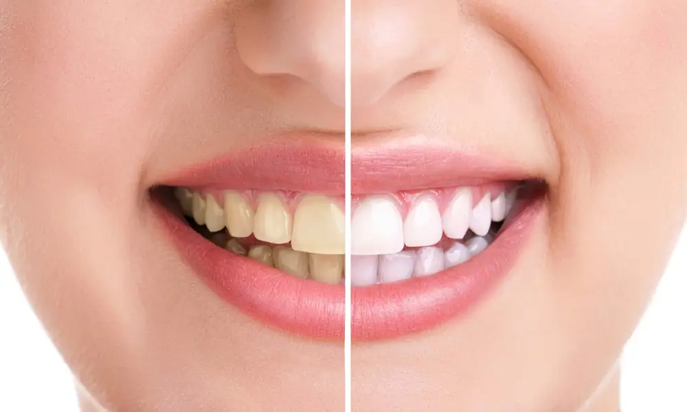 Teeth Whitening in Egmore